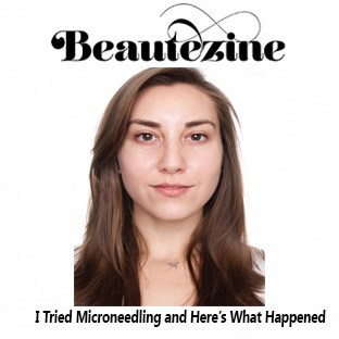 Beautezine - Microneedling
