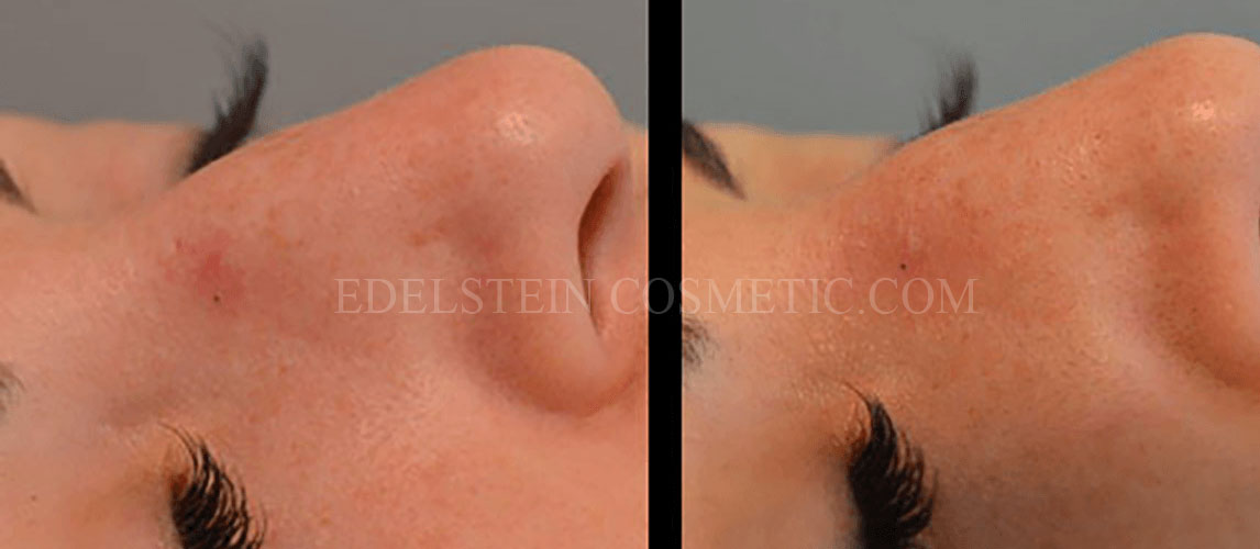 Spider Vein Removal case #26753