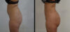 Brazilian Butt Lift case #26431 slider thumbnail