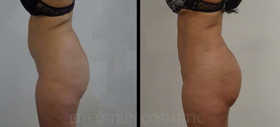 Brazilian-Butt-Lift-Toronto-Before-after-p01-new