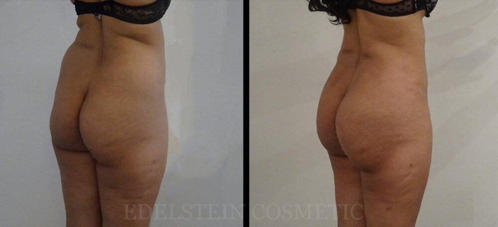 Brazilian Butt Lift case #26431