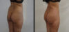 Brazilian Butt Lift case #26431 slider thumbnail