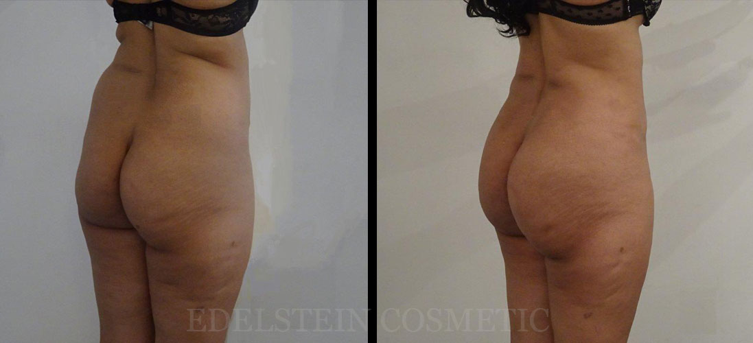 Brazilian-Butt-Lift-Toronto-Before-after-p01-side