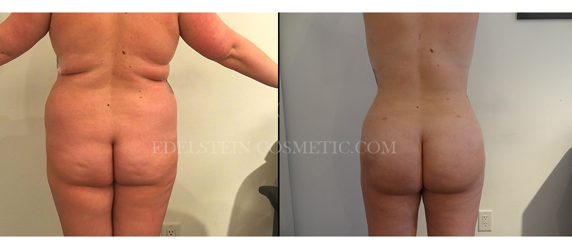 Brazilian Butt Lift case #26430