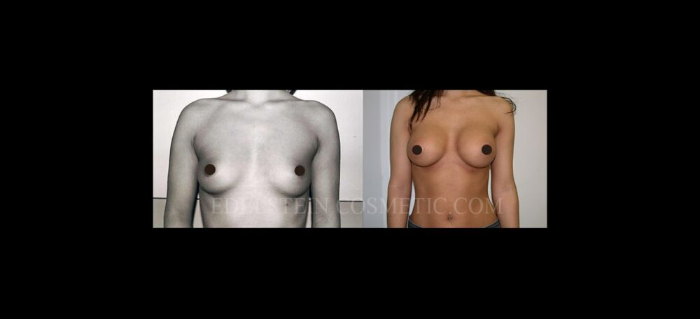 Breast Augmentation case #26870