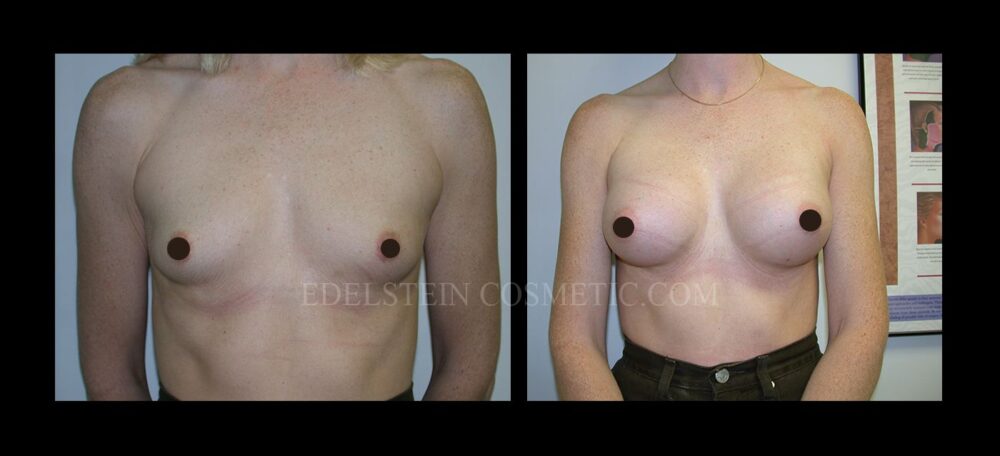 Breast Augmentation case #26869