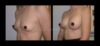 Breast Augmentation case #26869 slider thumbnail
