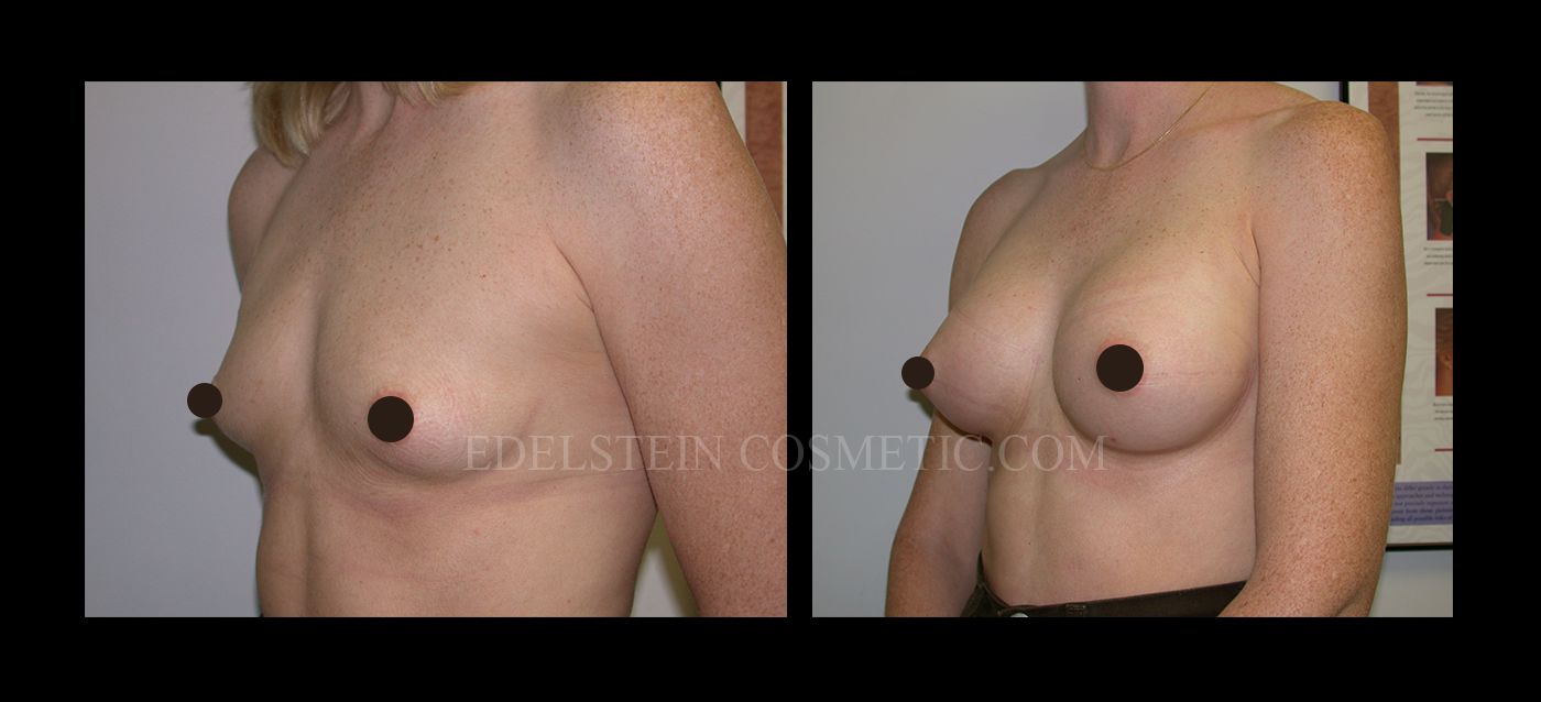 Breast Augmentation case #26869