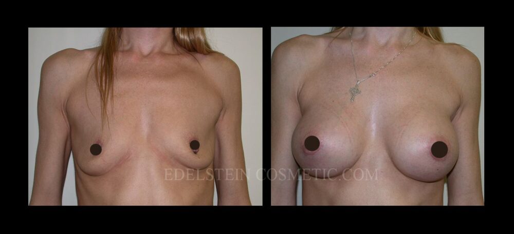 Breast Augmentation case #26868