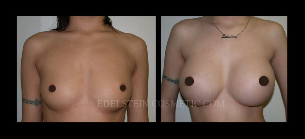 Breast Augmentation case #26867