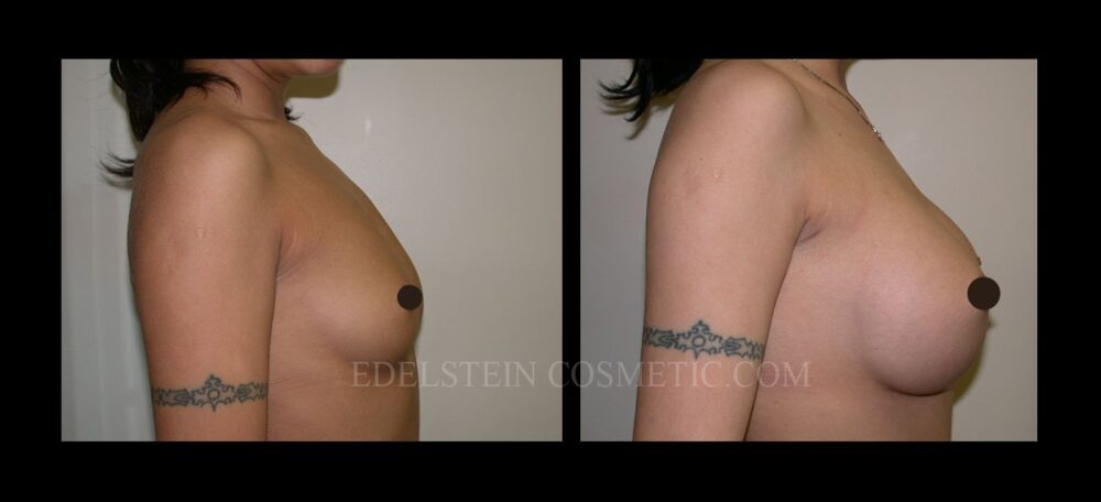 Breast Augmentation case #26867