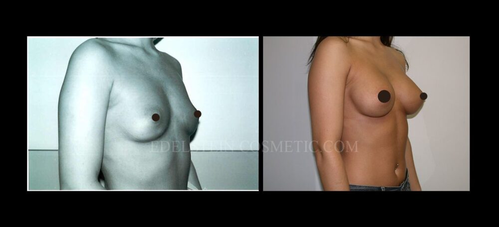 Breast Augmentation case #26870