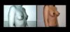 Breast Augmentation case #26870 slider thumbnail