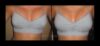 Breast Augmentation Recovery Diary case #26656 slider thumbnail