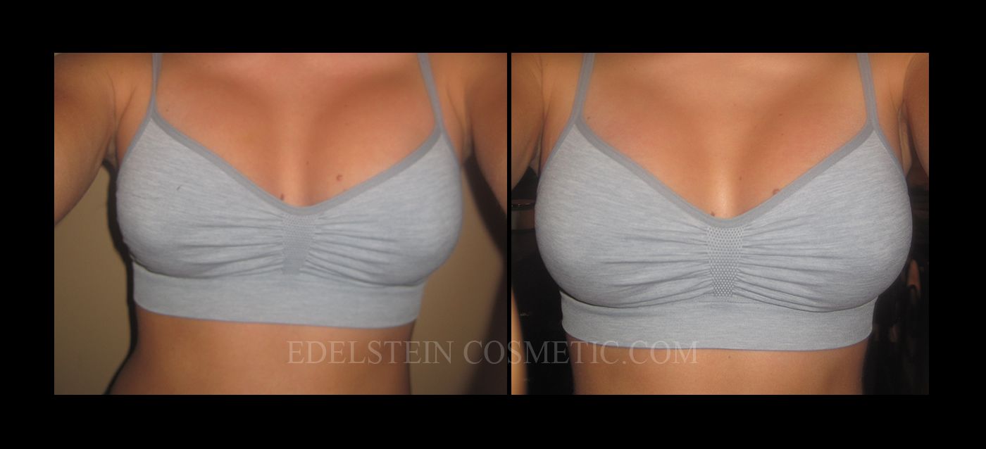 Breast Augmentation Recovery Diary case #26656