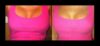 Breast Augmentation Recovery Diary case #26655 slider thumbnail