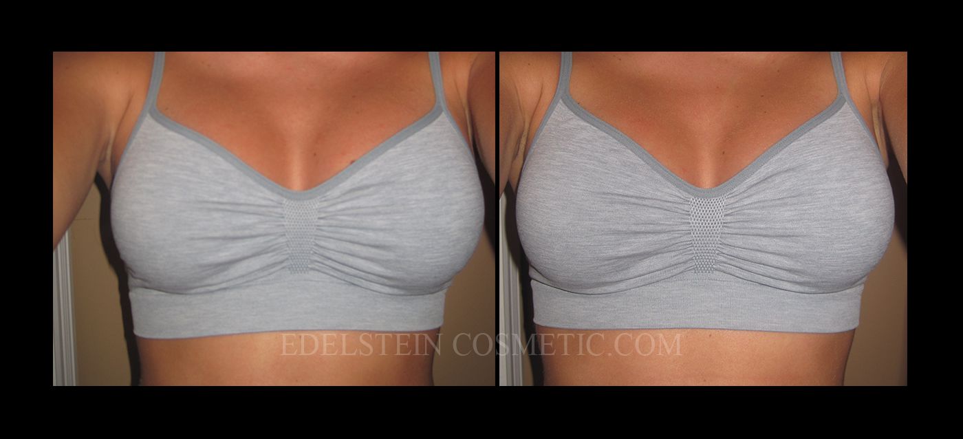 Breast Augmentation Recovery Diary case #26654