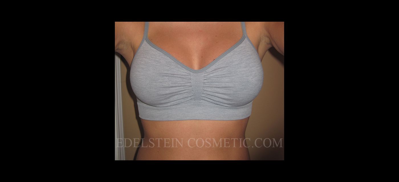 Breast Augmentation Recovery Diary case #26662