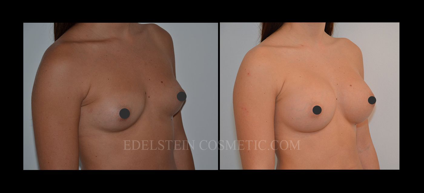 Breast Augmentation Recovery Diary case #26659