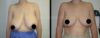 Breast Reduction case #26640 slider thumbnail