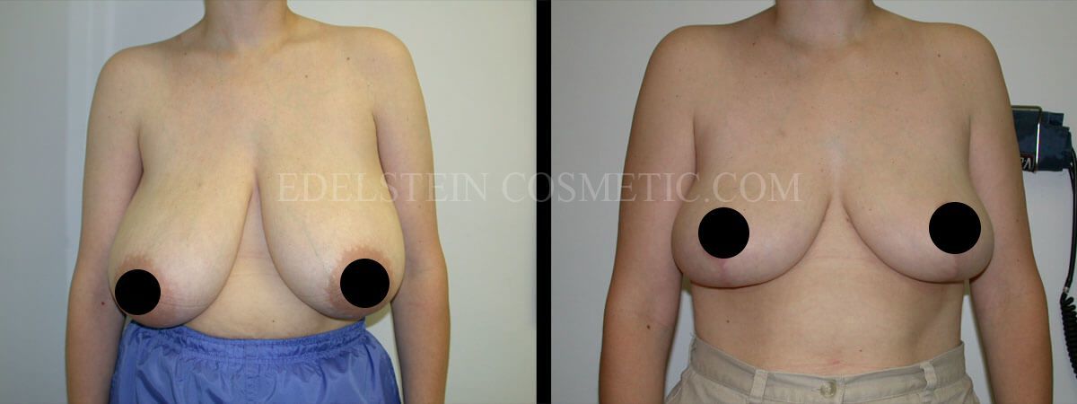 Breast Reduction case #26640