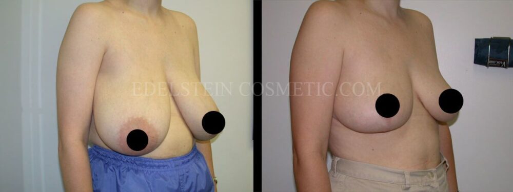 Breast Reduction case #26640