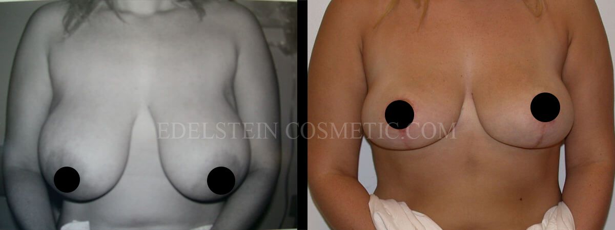 Breast Reduction case #26641