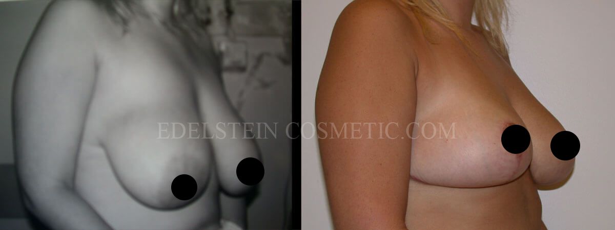 Breast Reduction case #26641