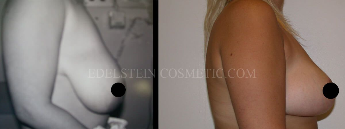 Breast Reduction case #26641