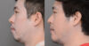 Chin Augmentation case #26827 slider thumbnail