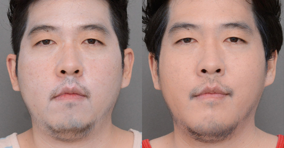 Chin Augmentation case #26827