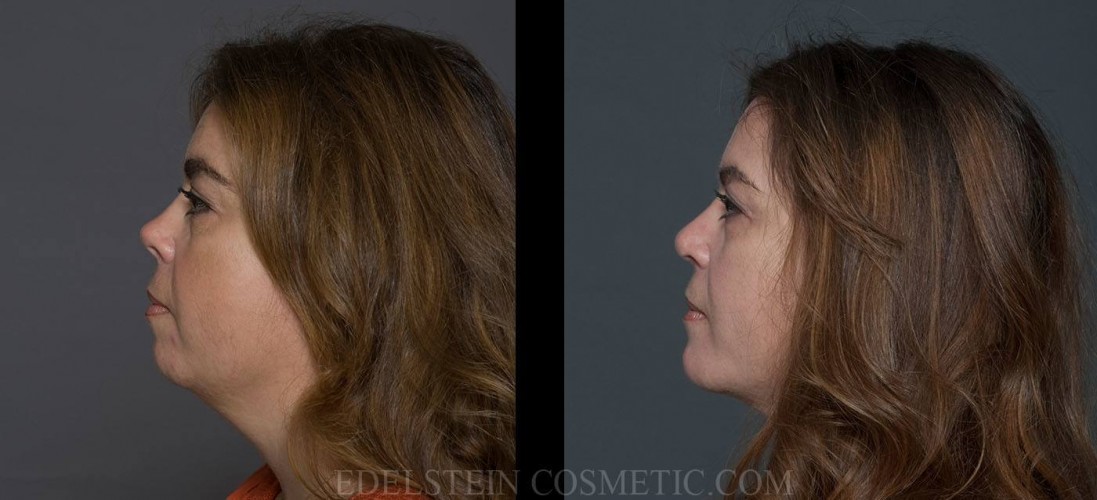 Chin Augmentation case #26824