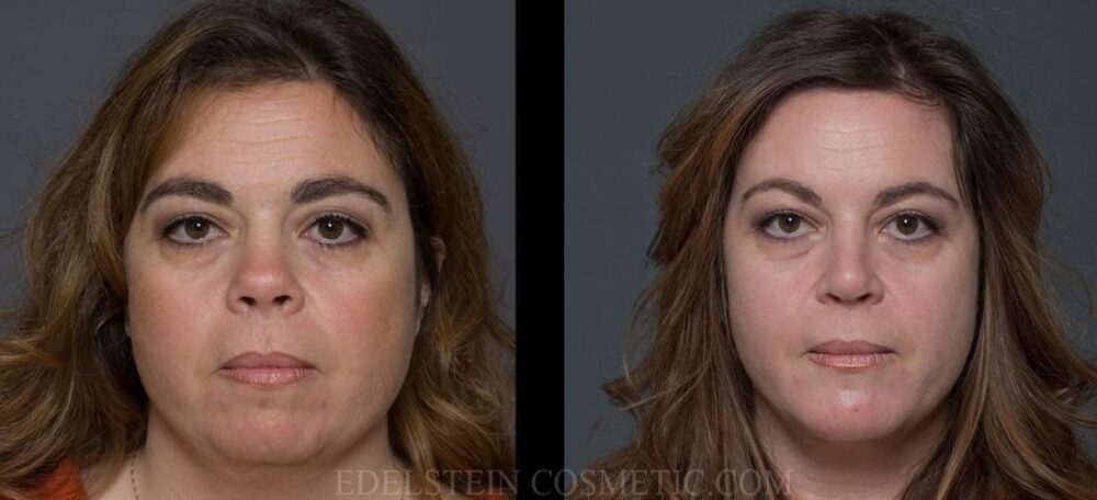 Chin Augmentation case #26824