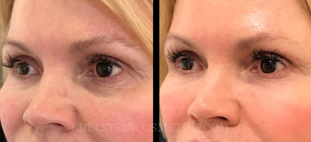 Dermal Fillers case #26681