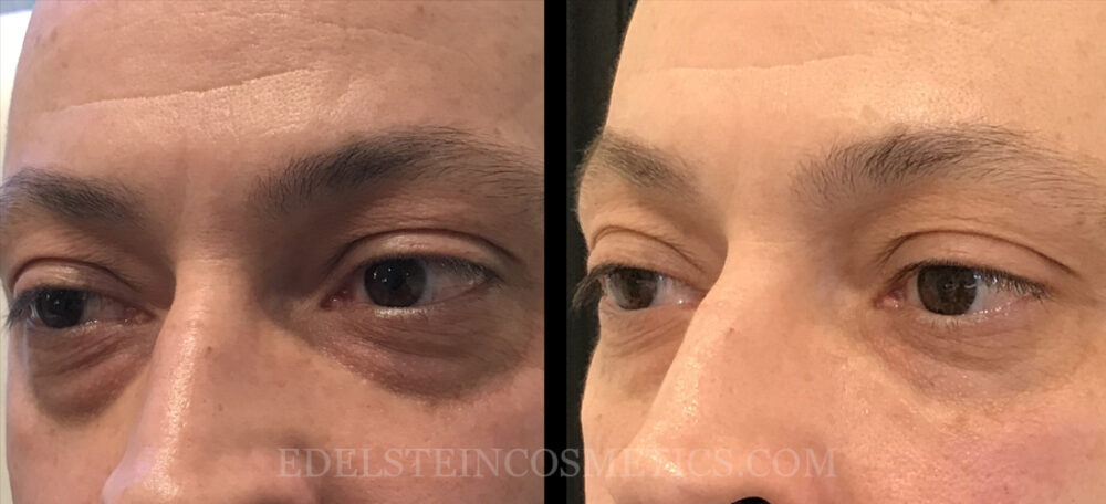 Dermal Fillers case #26683