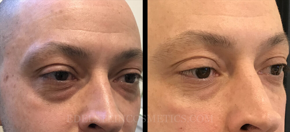 Dermal Fillers case #26683