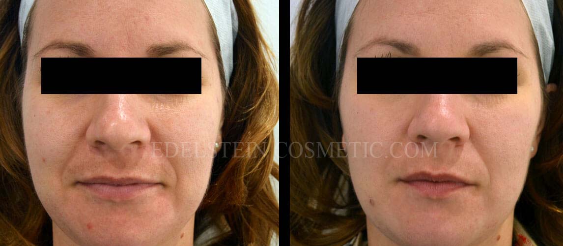 Facial Peel case #26701