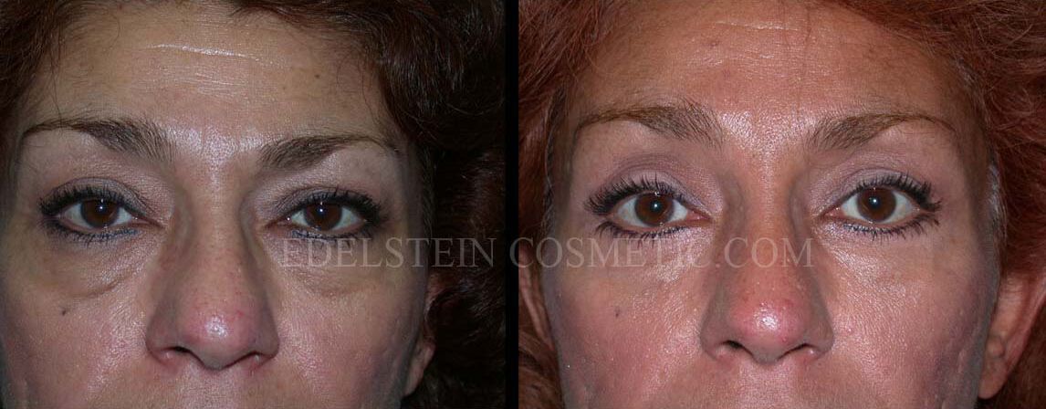 Forehead Lift case #26823