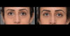 Blepharoplasty case #26813 slider thumbnail