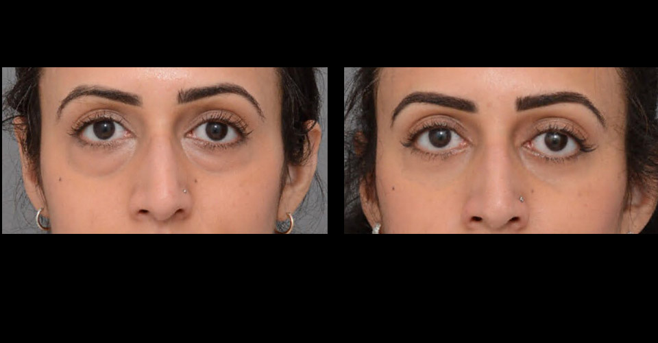 Lower-Blepharoplasty-P1