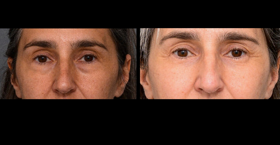 Lower-Blepharoplasty-P2