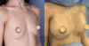 Breast Augmentation case #26663 slider thumbnail