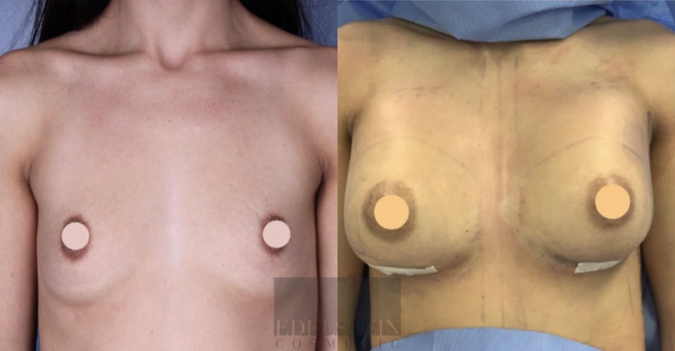 Breast Augmentation case #26663