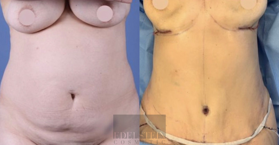 Tummy Tuck case #26593