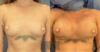 Breast Augmentation case #26663 slider thumbnail