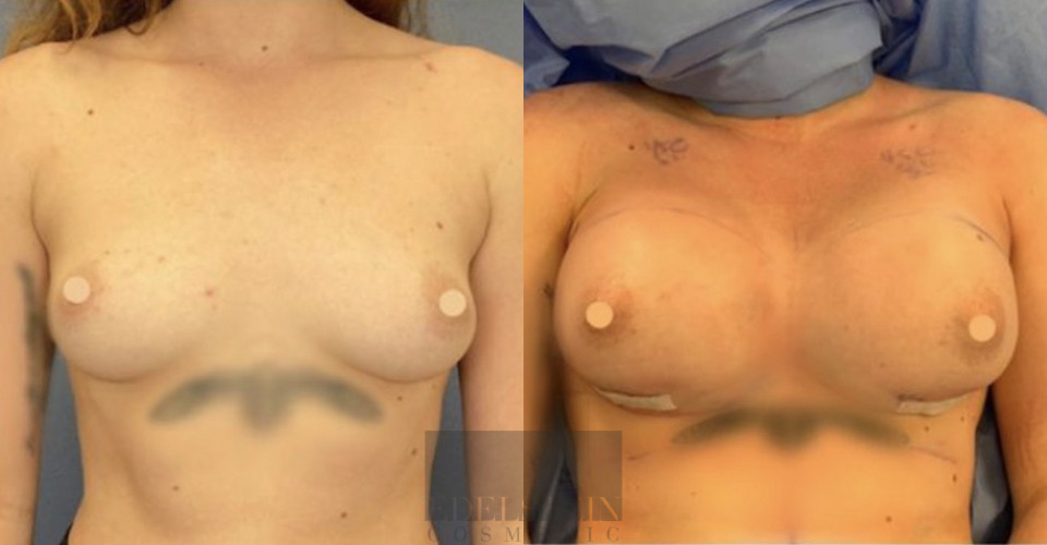 Breast Augmentation case #26663