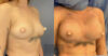 Breast Augmentation case #26663 slider thumbnail