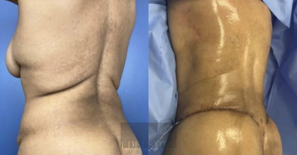 Tummy Tuck case #26592