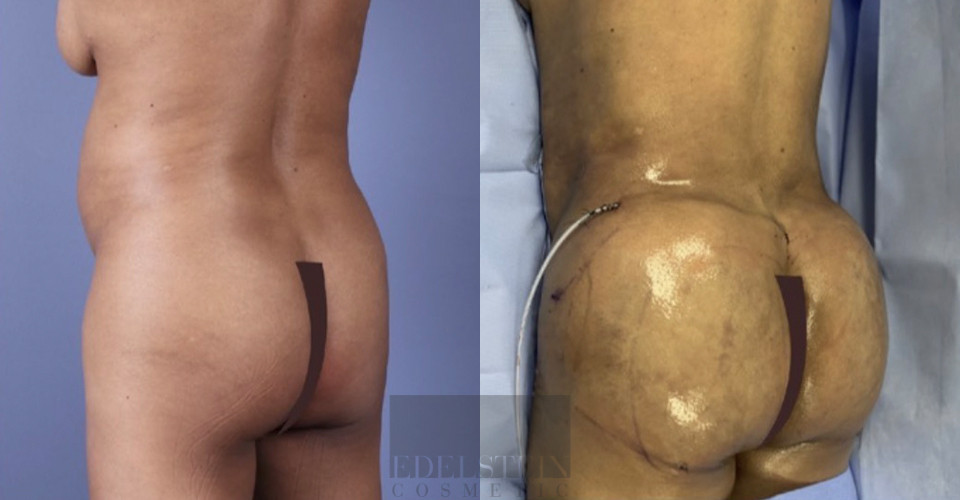 Brazilian Butt Lift case #26429