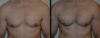 Pectoral Implants case #26394 slider thumbnail